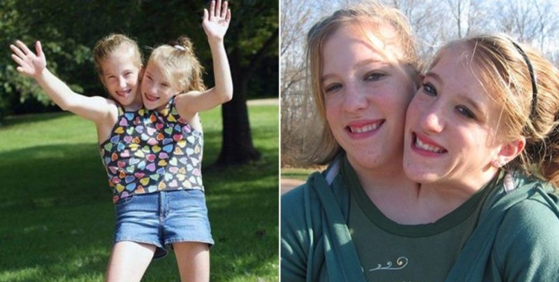 One life for two: what the most famous Siamese twins Brittany and Abigail look like now