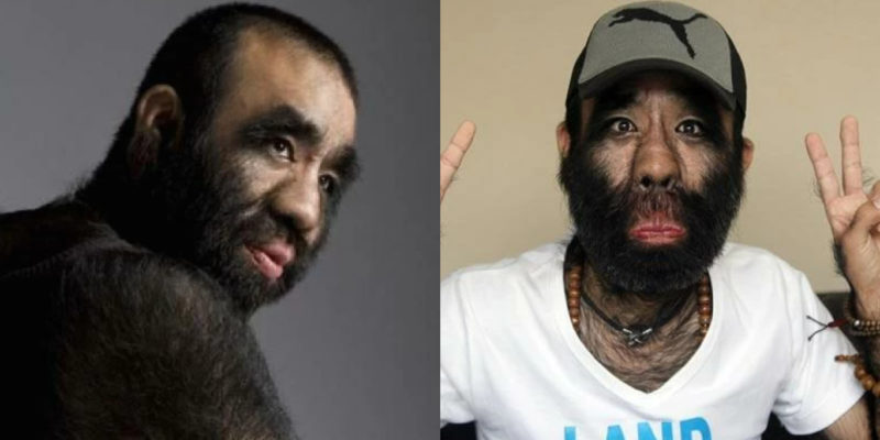 The hairiest man on the planet, who was called King Kong at school, finally found his love