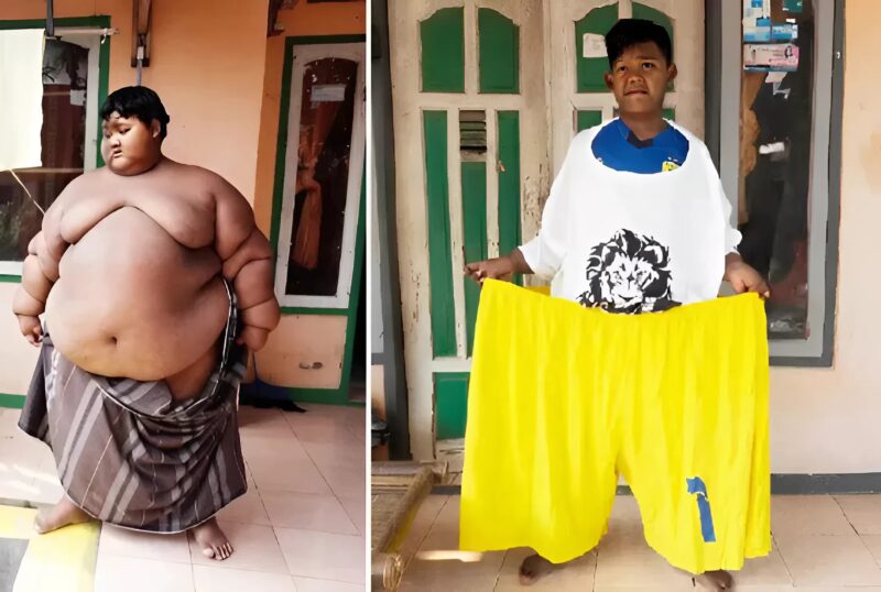 At 10 years old, this boy weighed nearly 191 kg and was considered the heaviest child in the world: today he has slimmed down and weighs only 85 kg