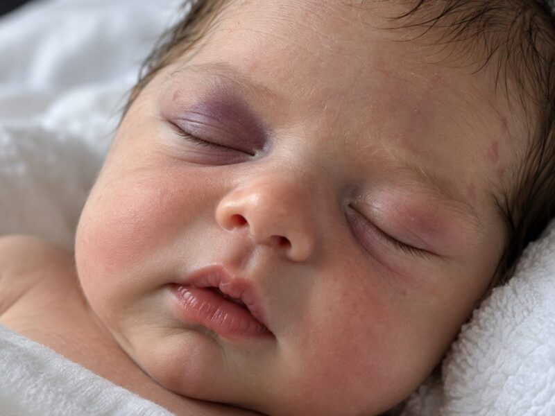 A few days after our baby was born, a strange mark appeared on their face… At the hospital, the doctors gave us some shocking news